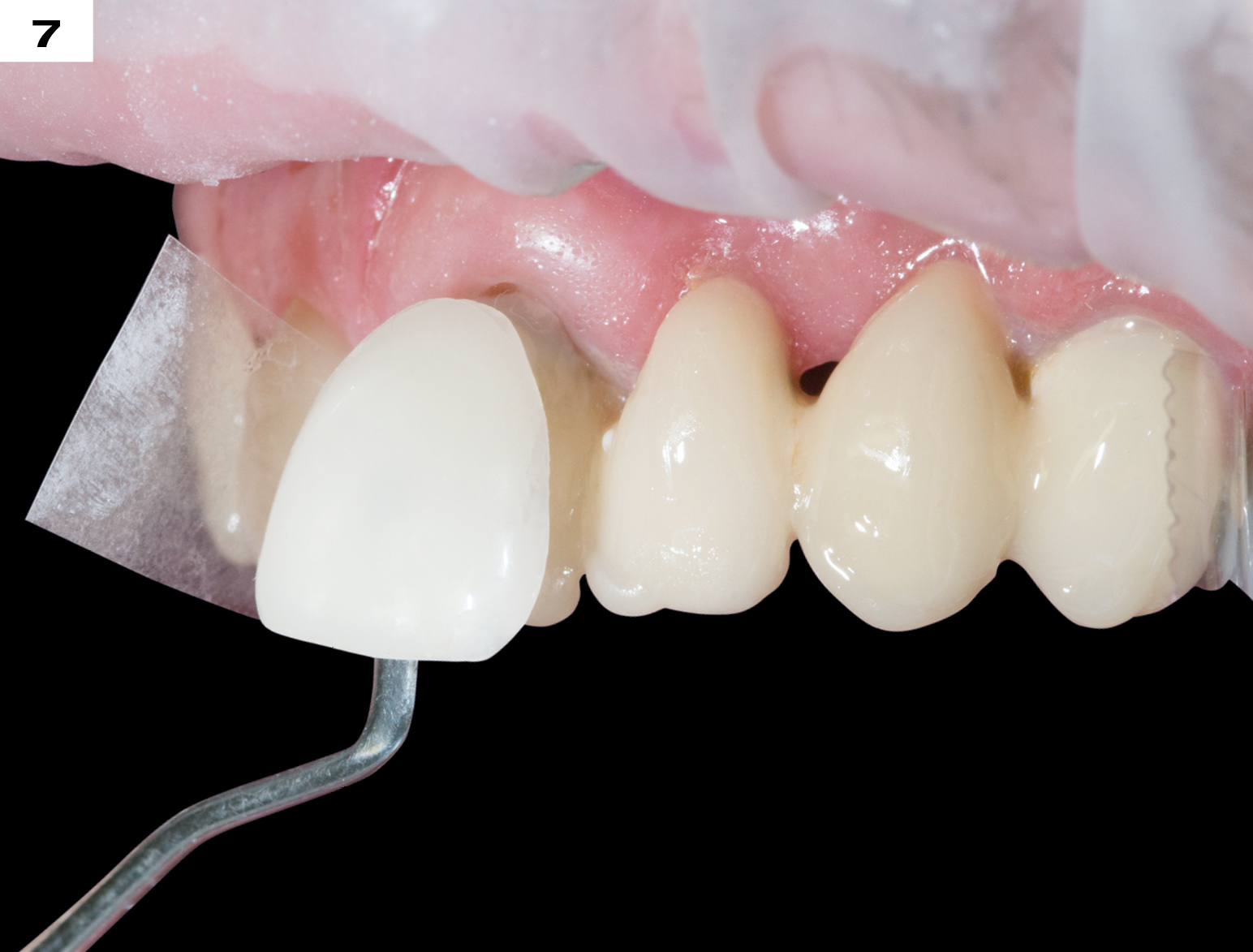 Άμεσες Προκατασκευασμένες Όψεις Σύνθετης Ρητίνης